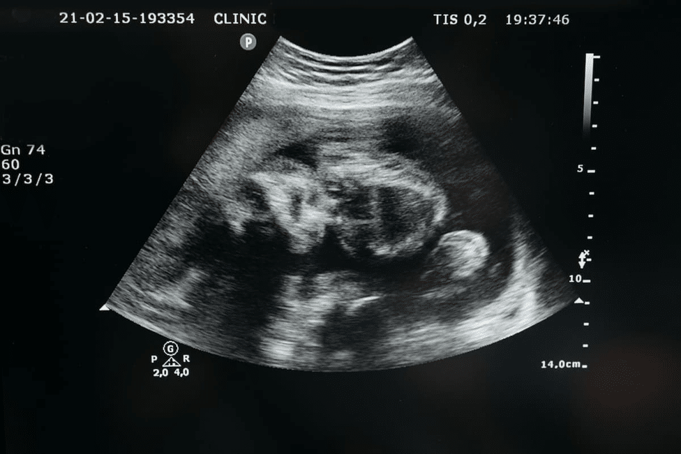 11 week belly